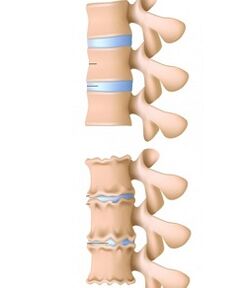 здрав гръбначен стълб и гръбначен стълб, засегнати от остеохондроза