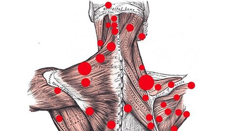 Задействащи точки в мускулите, които провокират миофасциална болка в гърба