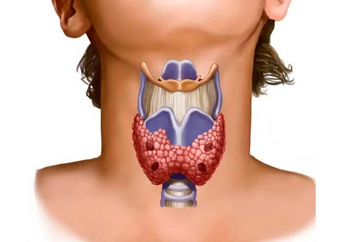 проблеми с щитовидната жлеза като причина за болки във врата